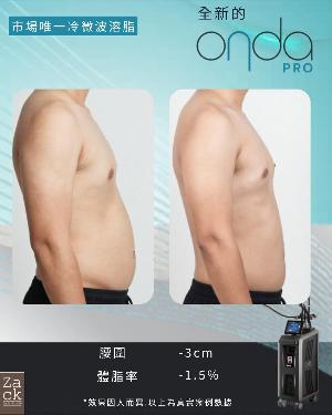 OndaPro冷微波溶脂療程-體驗