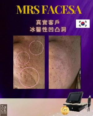 Derma Roller微针重塑疗程-体验价