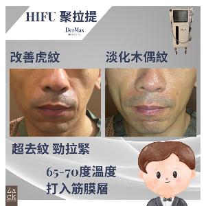 DerMax Hifu 面部提拉療程-體驗價