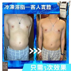 Cryolipolysis 冰感定位纖脂療程(2格)-體驗價